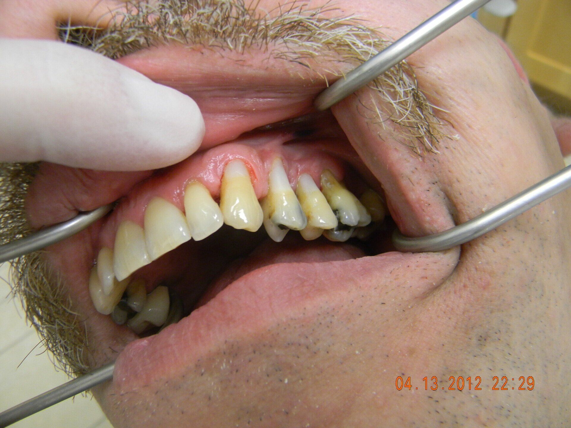 A man with a beard is getting his teeth examined by a dentist