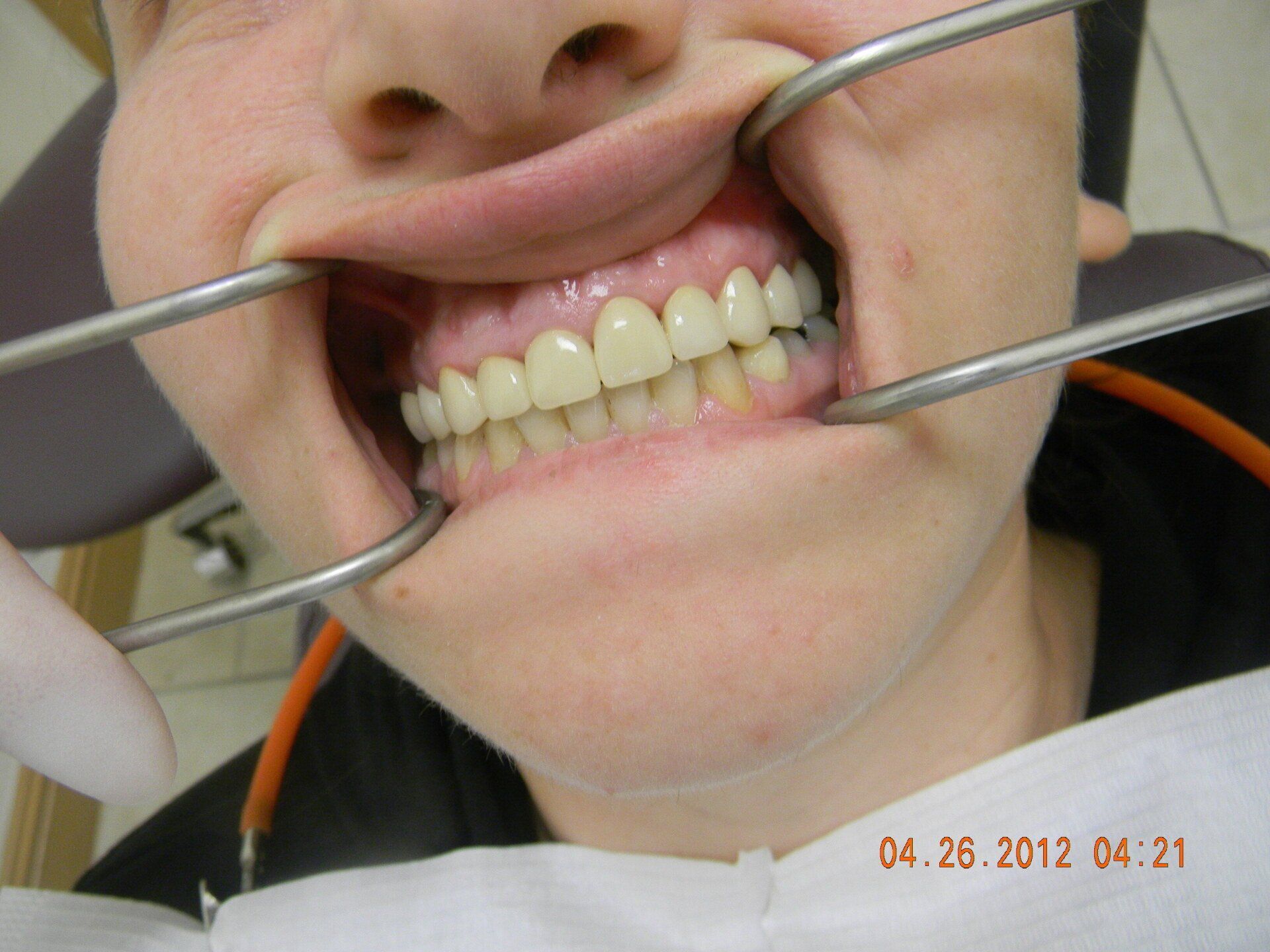 A woman is getting her teeth examined by a dentist