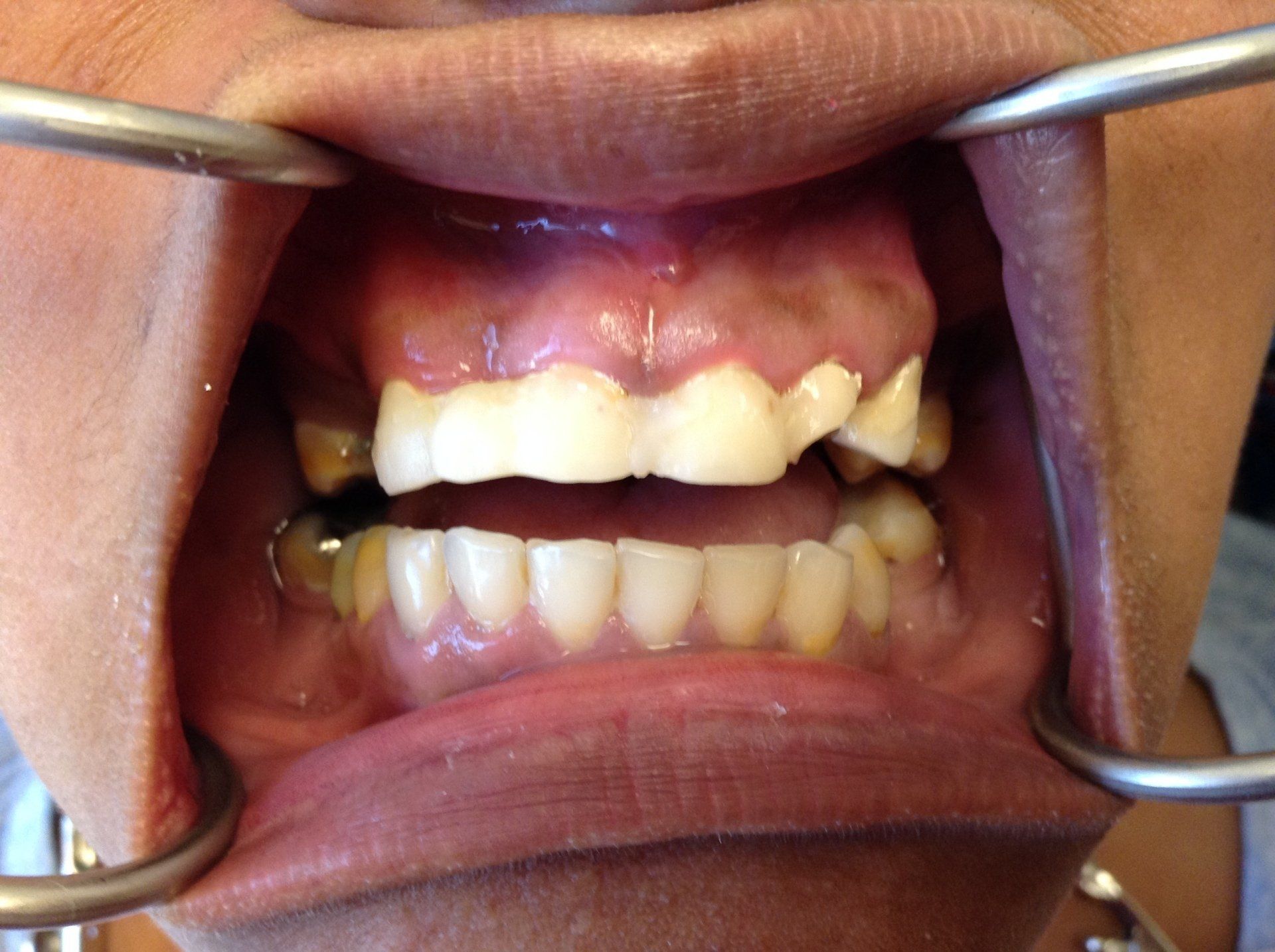 A close up of a person 's mouth with braces on their teeth