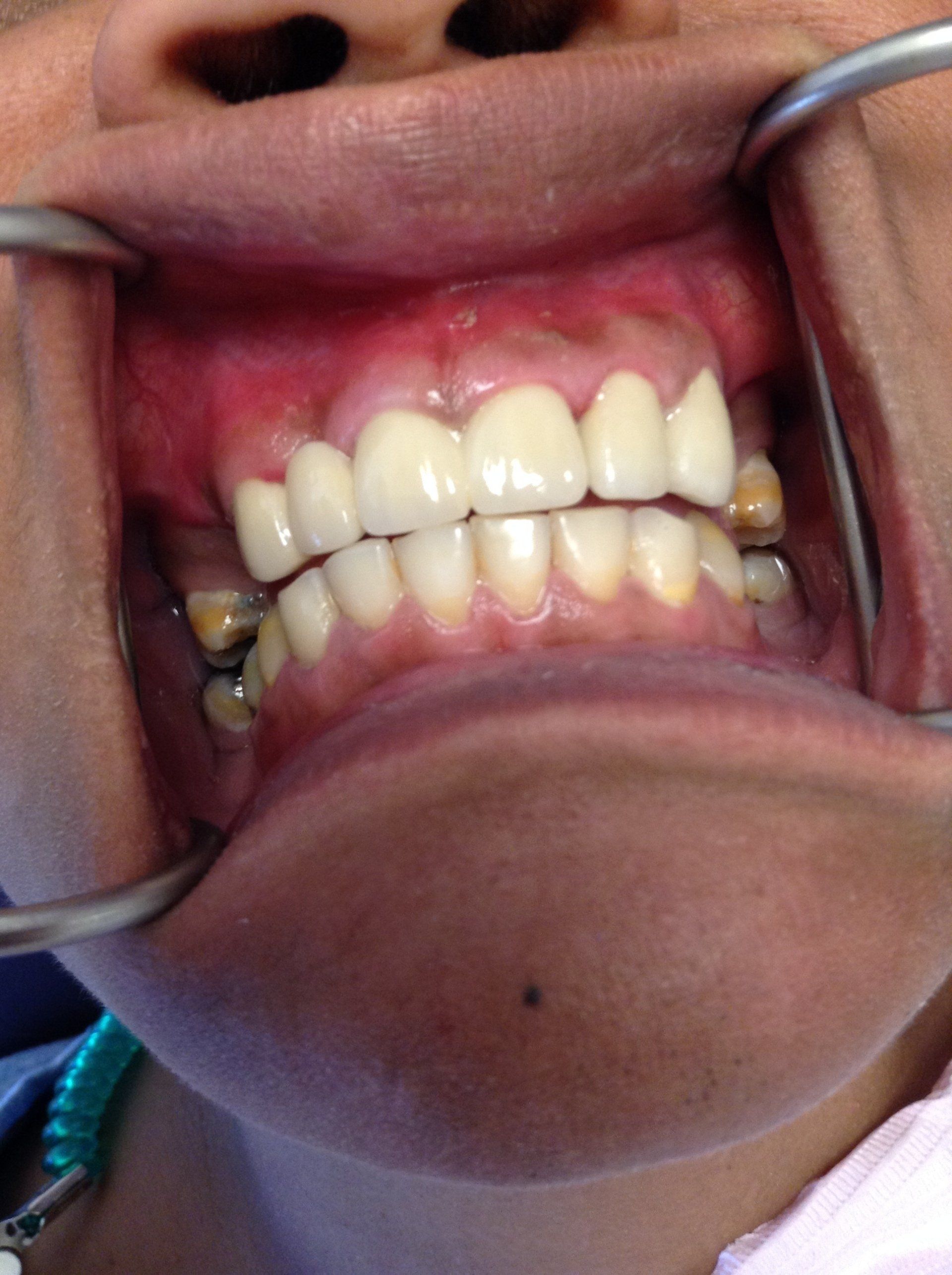 A close up of a person 's mouth with dental instruments in it