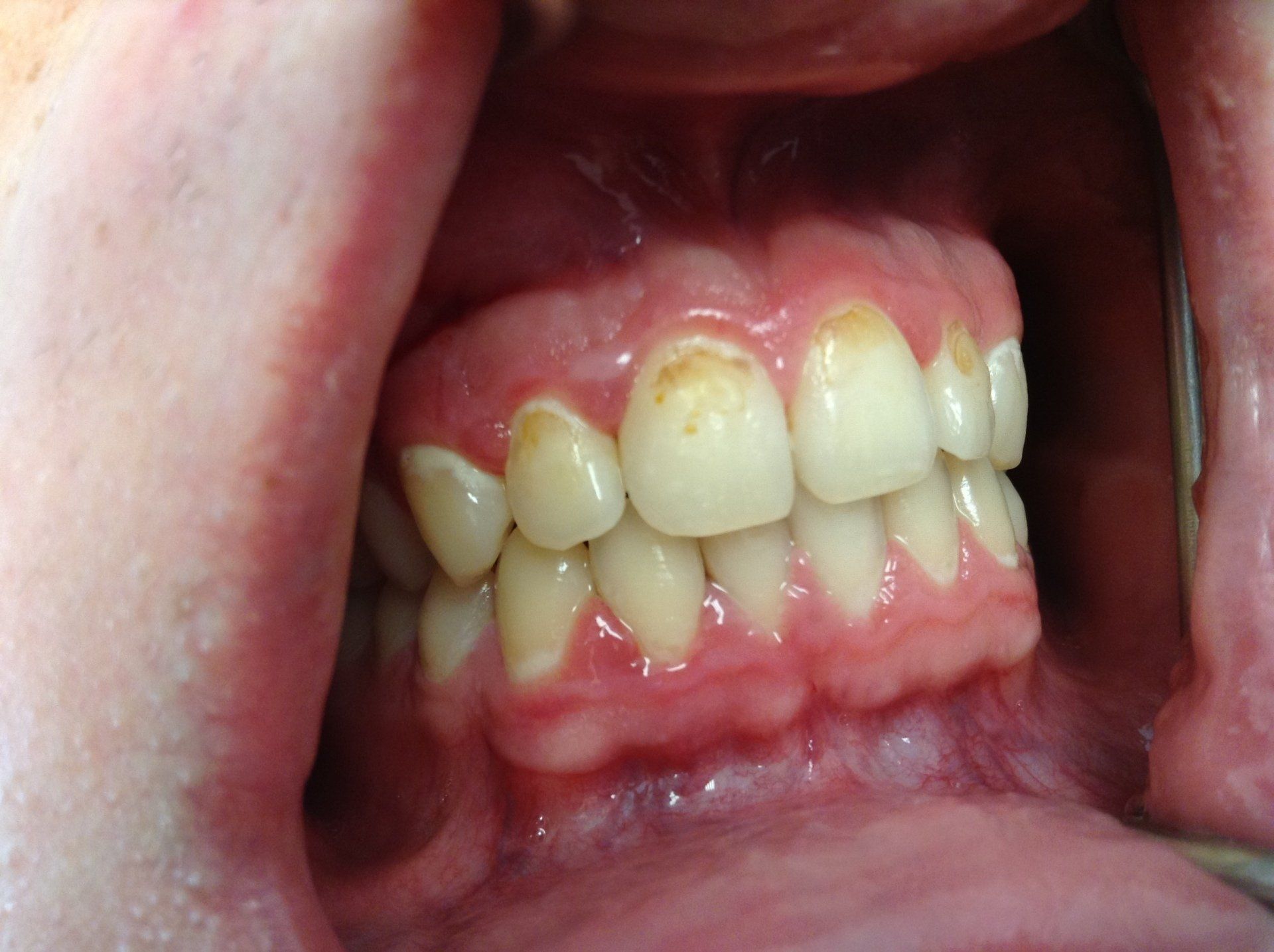A close up of a person 's mouth showing their teeth