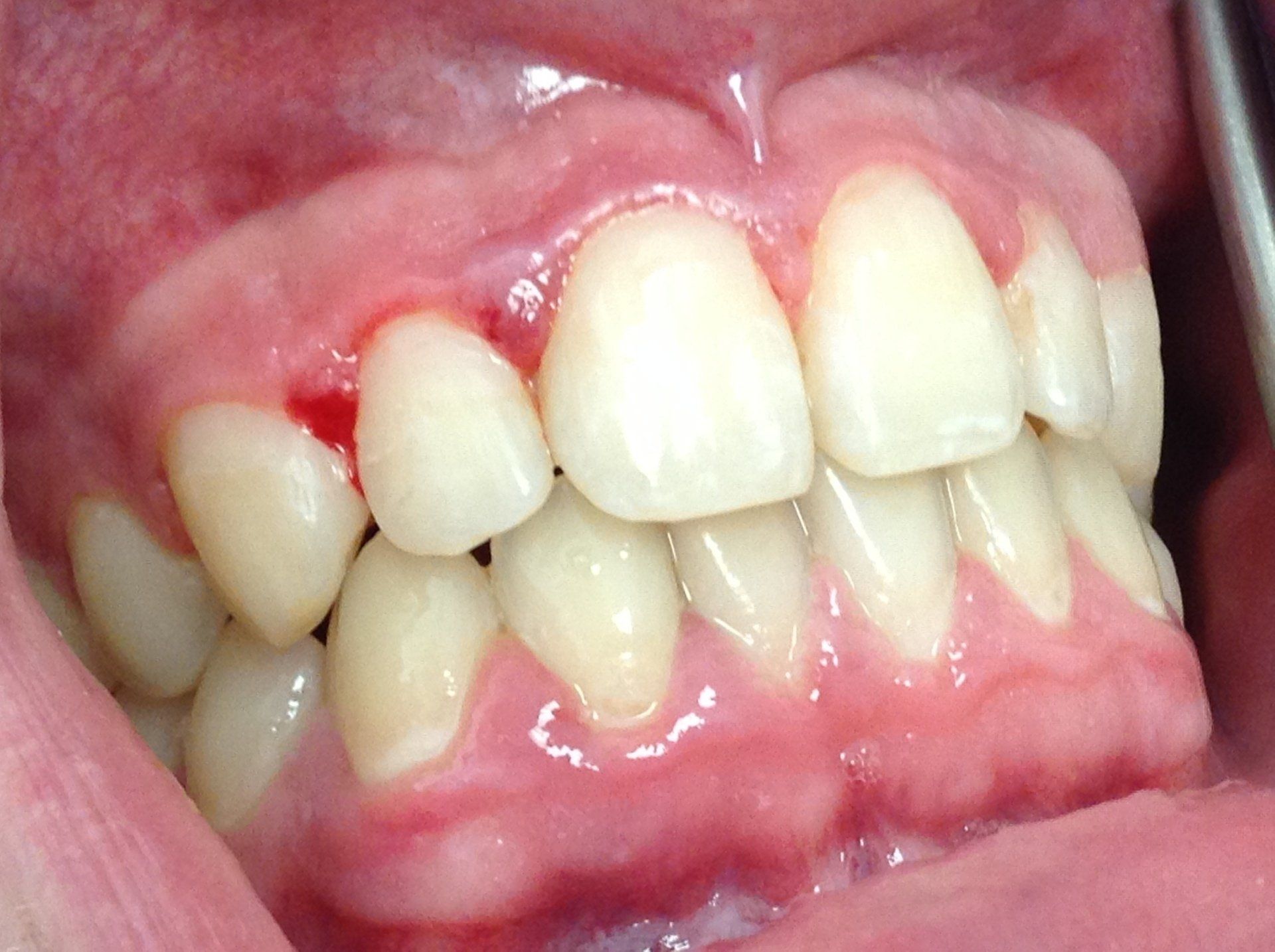 A close up of a person 's mouth with a tooth that is bleeding.