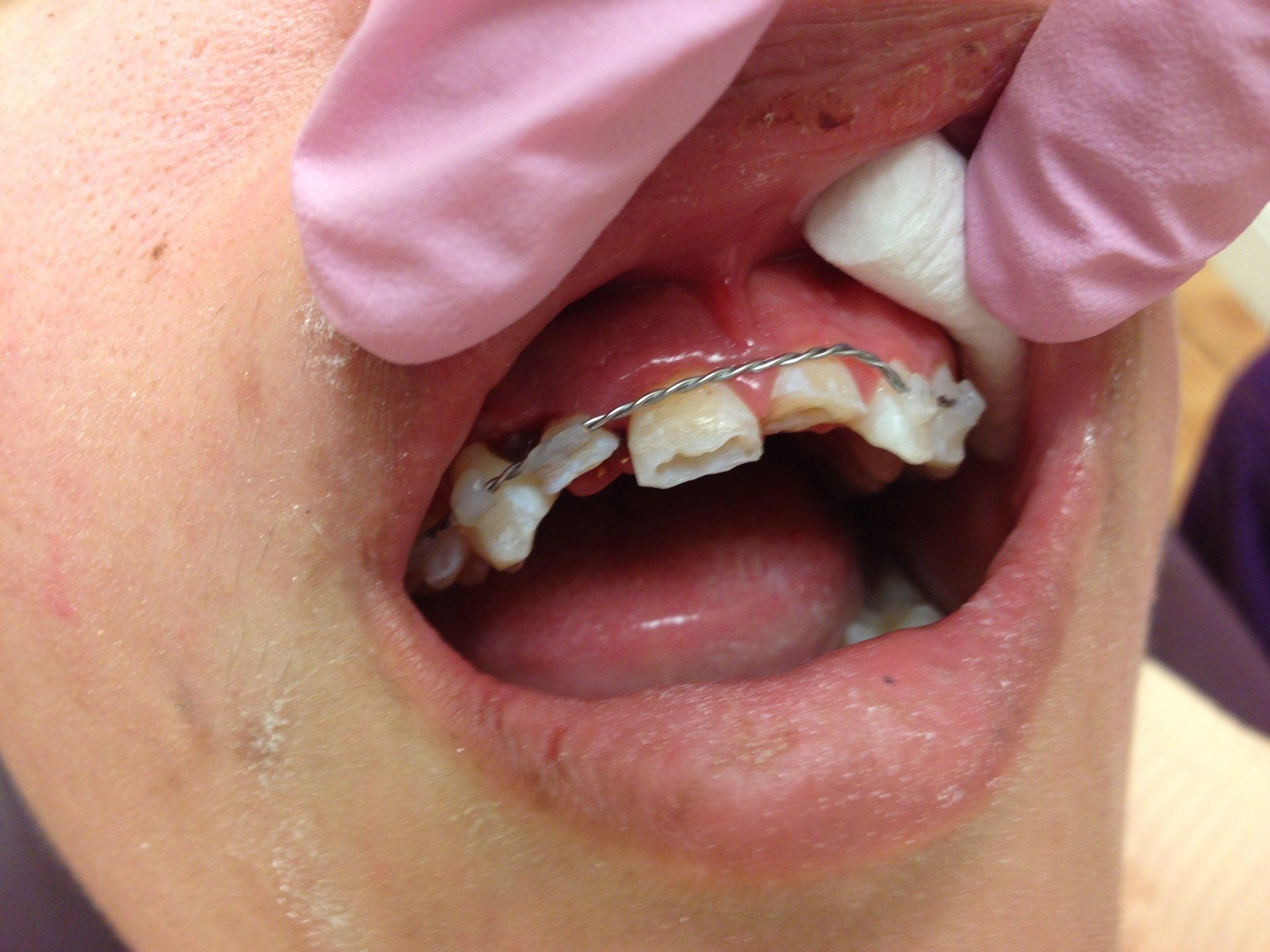 A close up of a person 's mouth with braces on their teeth