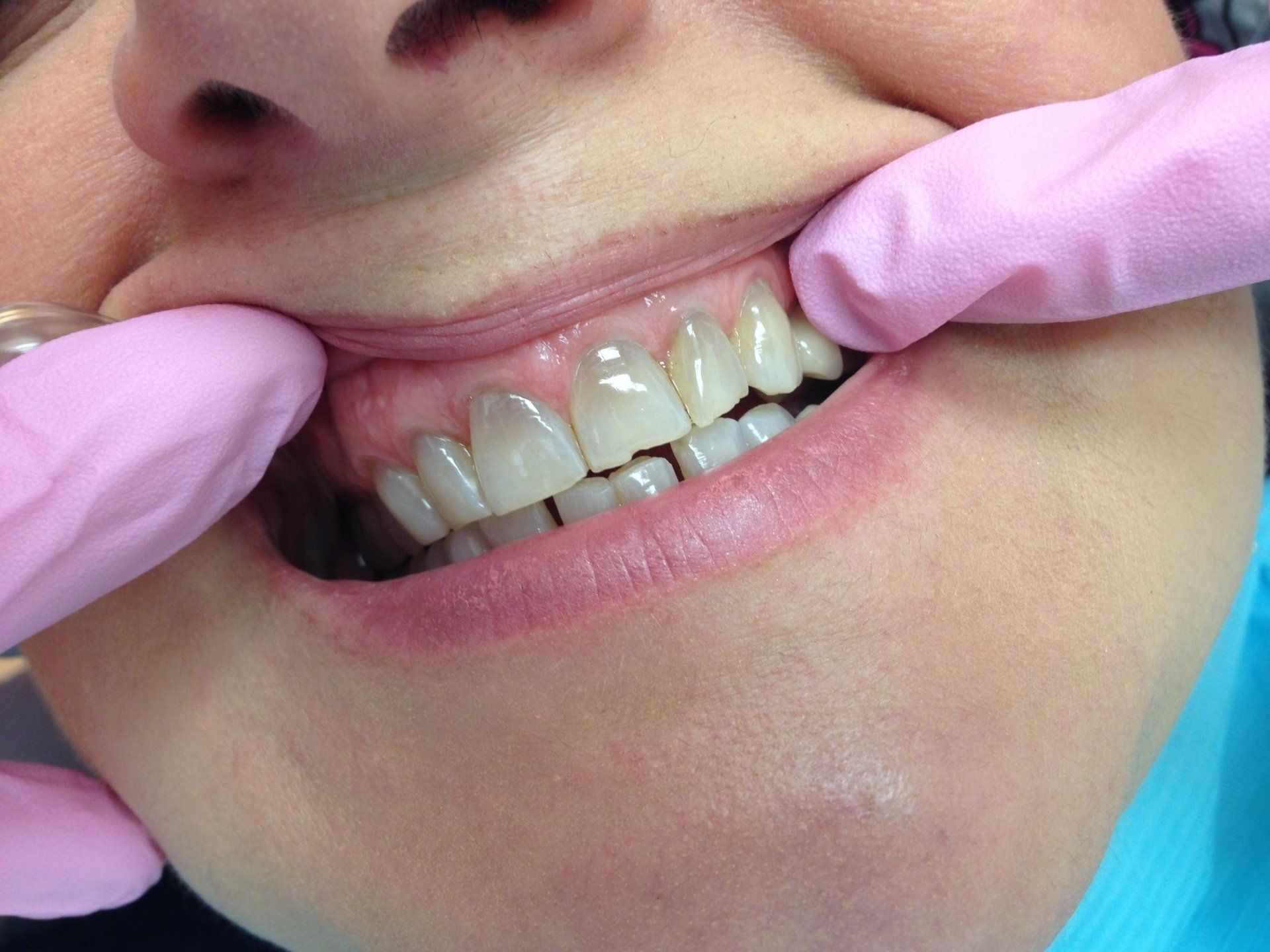 A close up of a person 's teeth with pink gloves on