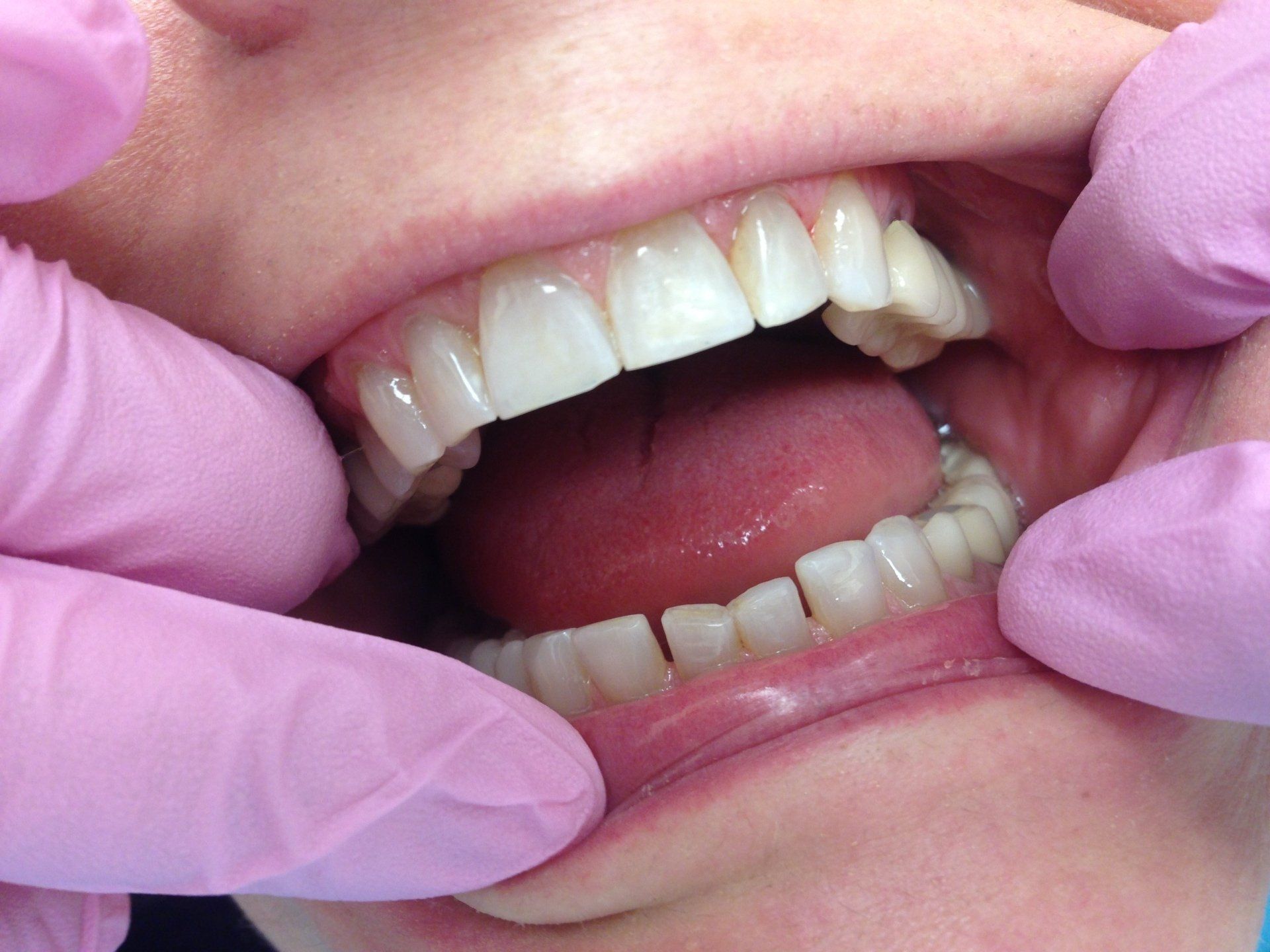 A close up of a person 's mouth with pink gloves on
