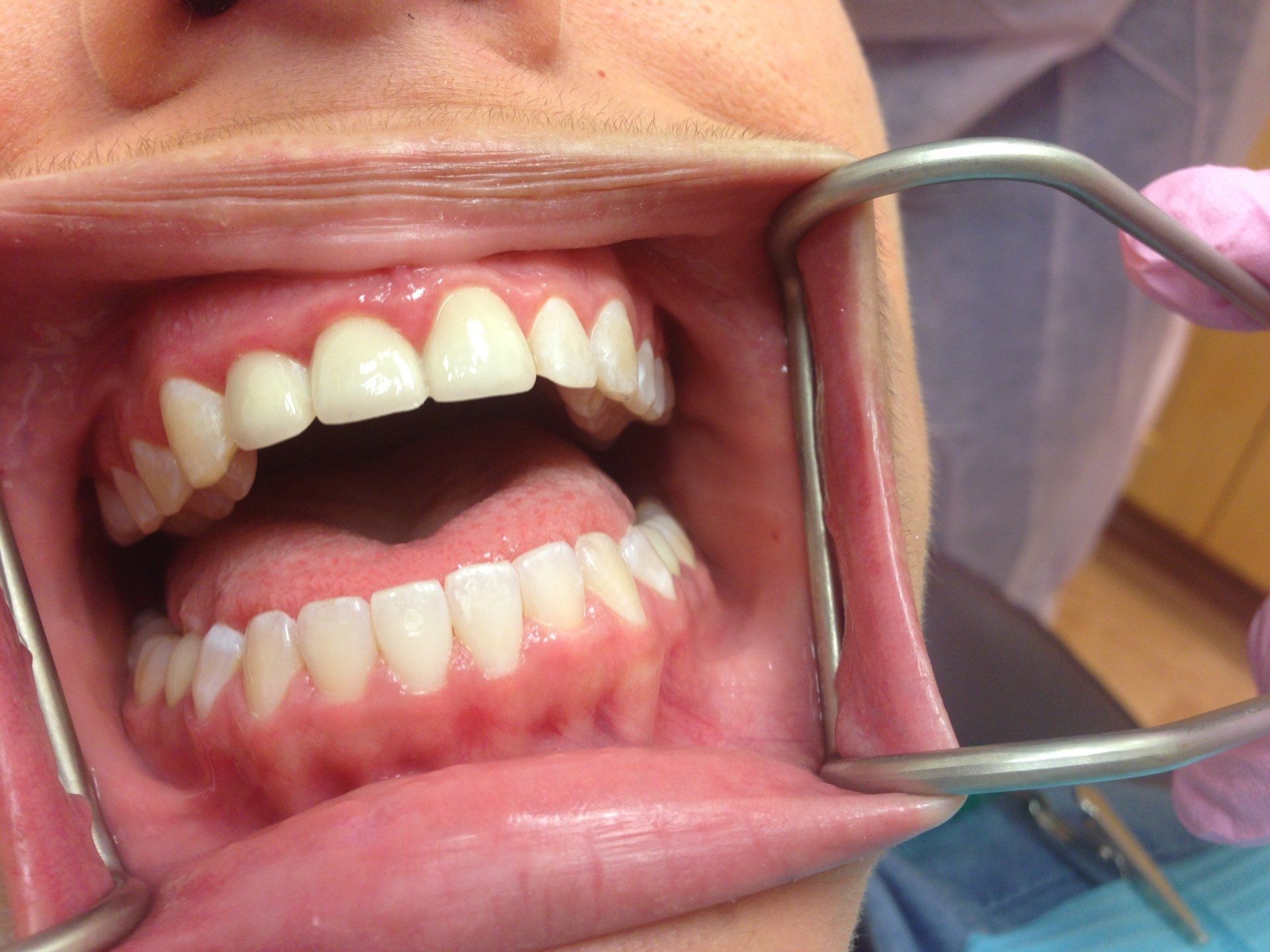 A woman is getting her teeth examined by a dentist.