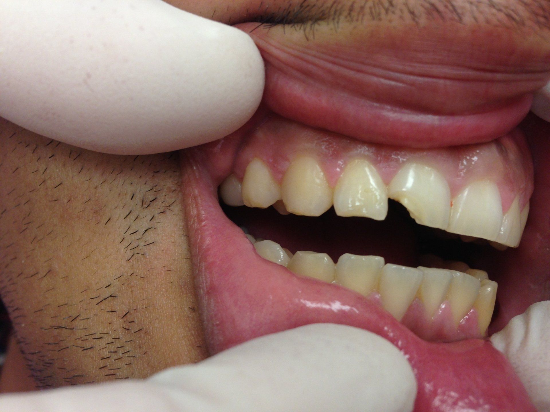 A close up of a man 's mouth with a broken tooth