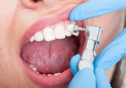 dental cleaning