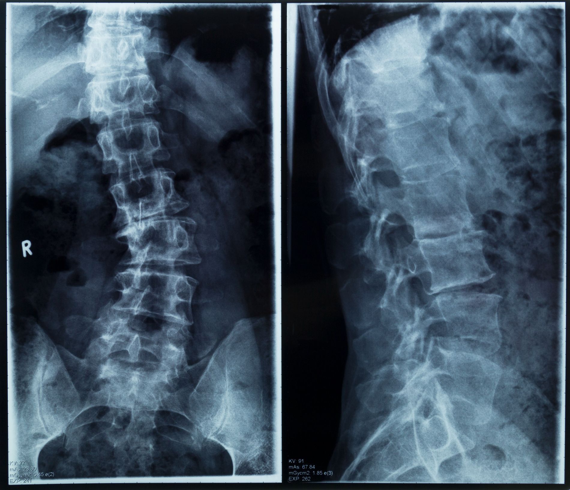 radiografia della colonna vertebrale