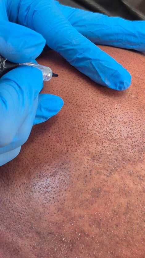 Primo piano di una testa dalla pelle scura con l'attaccatura dei capelli modellata con uno strumento di precisione.