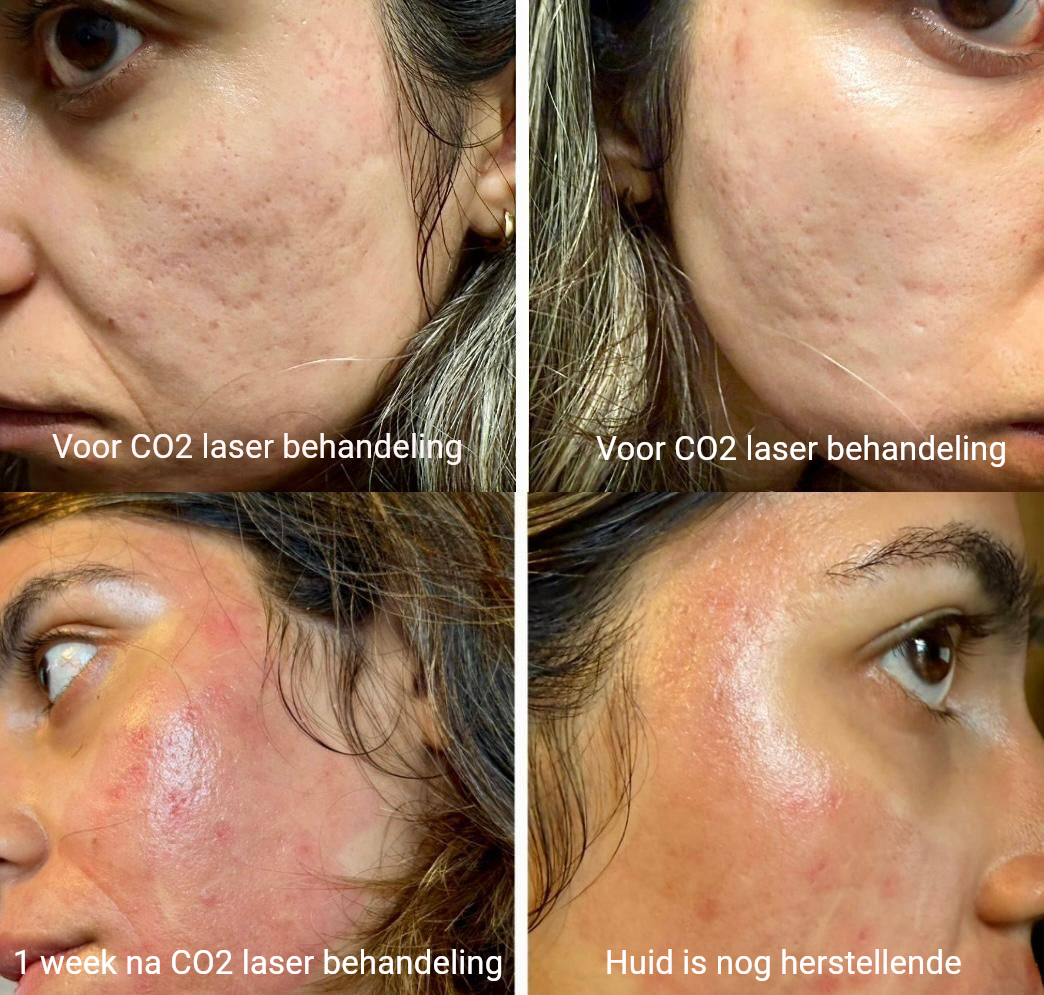 Resultaat CO2 fractional laser na één week.