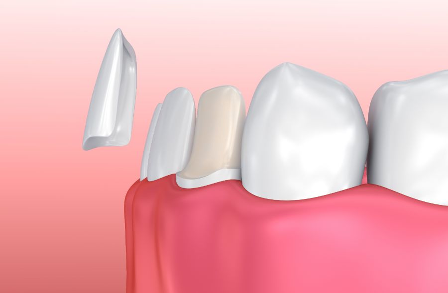 grafica impronta digitale dente