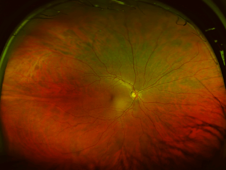 Eye Disease — Male Patient in Ophthalmology Clinic in Lawton, OK Eye Disease — Male Patient in Ophthalmology Clinic in Lawton, OK