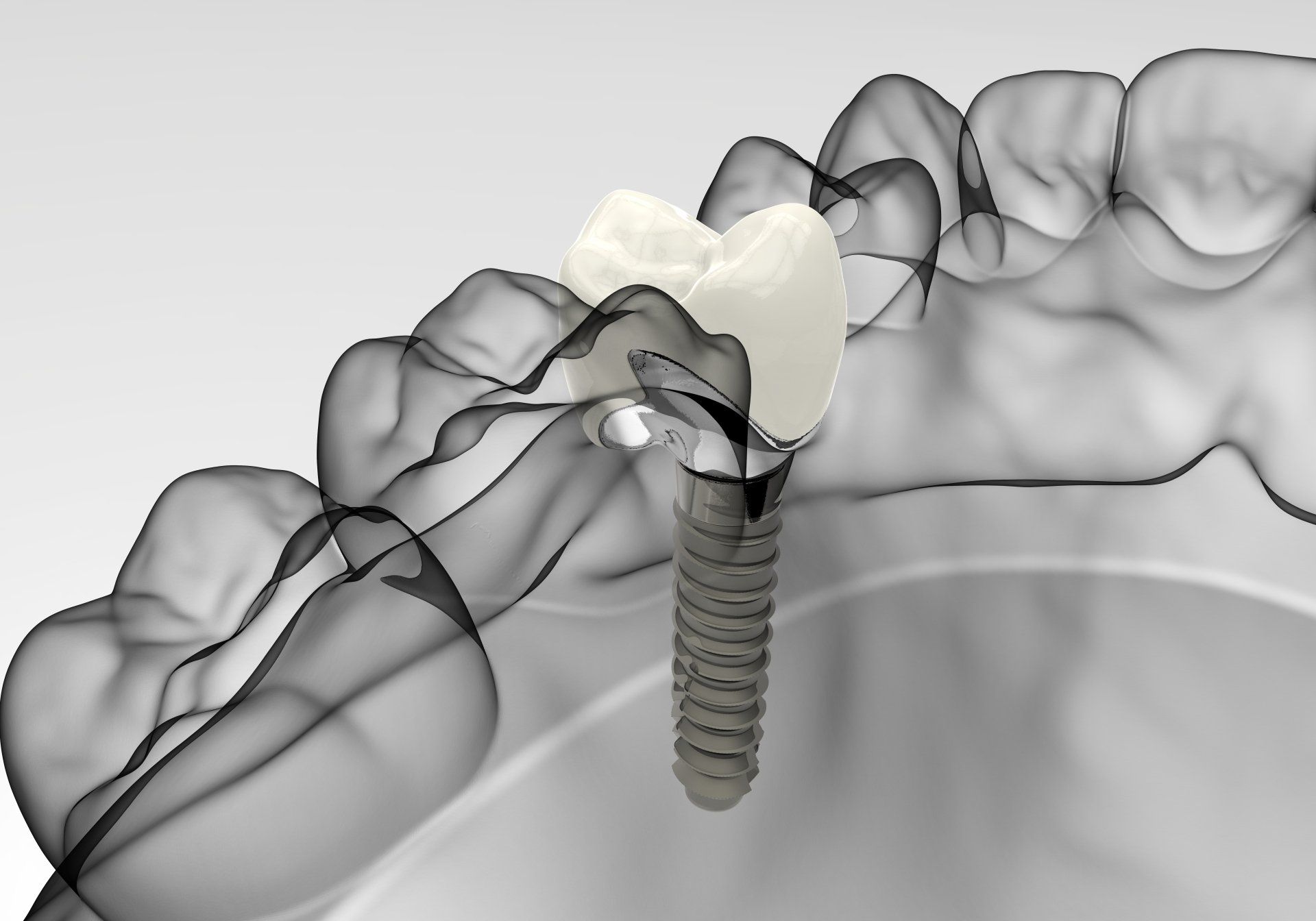 Impianto dentale 3D posizionato in un modello di mascella molare con corona annessa