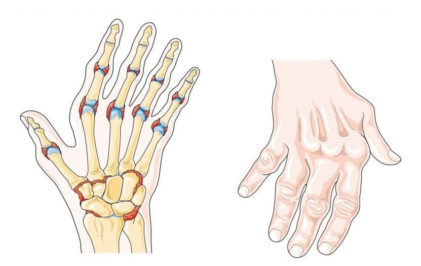 Degeneration in the hands illustration