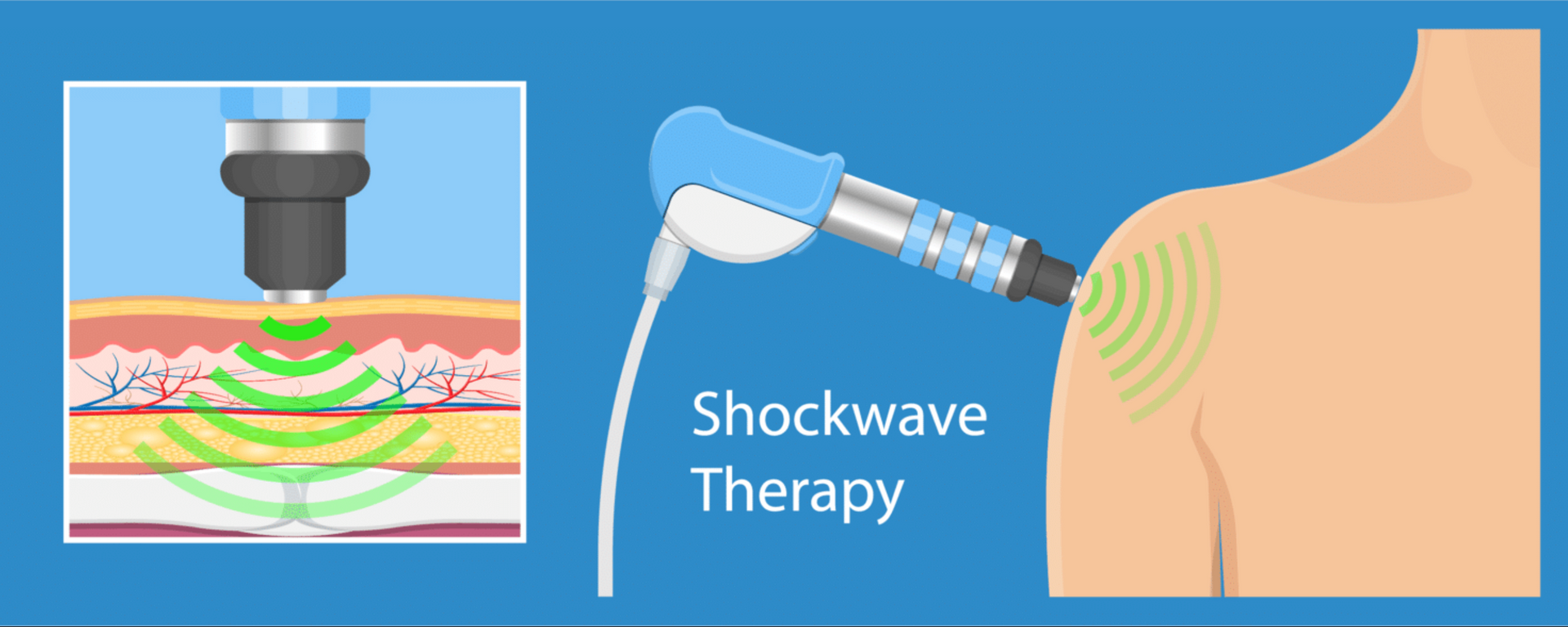 shockwave therapy
