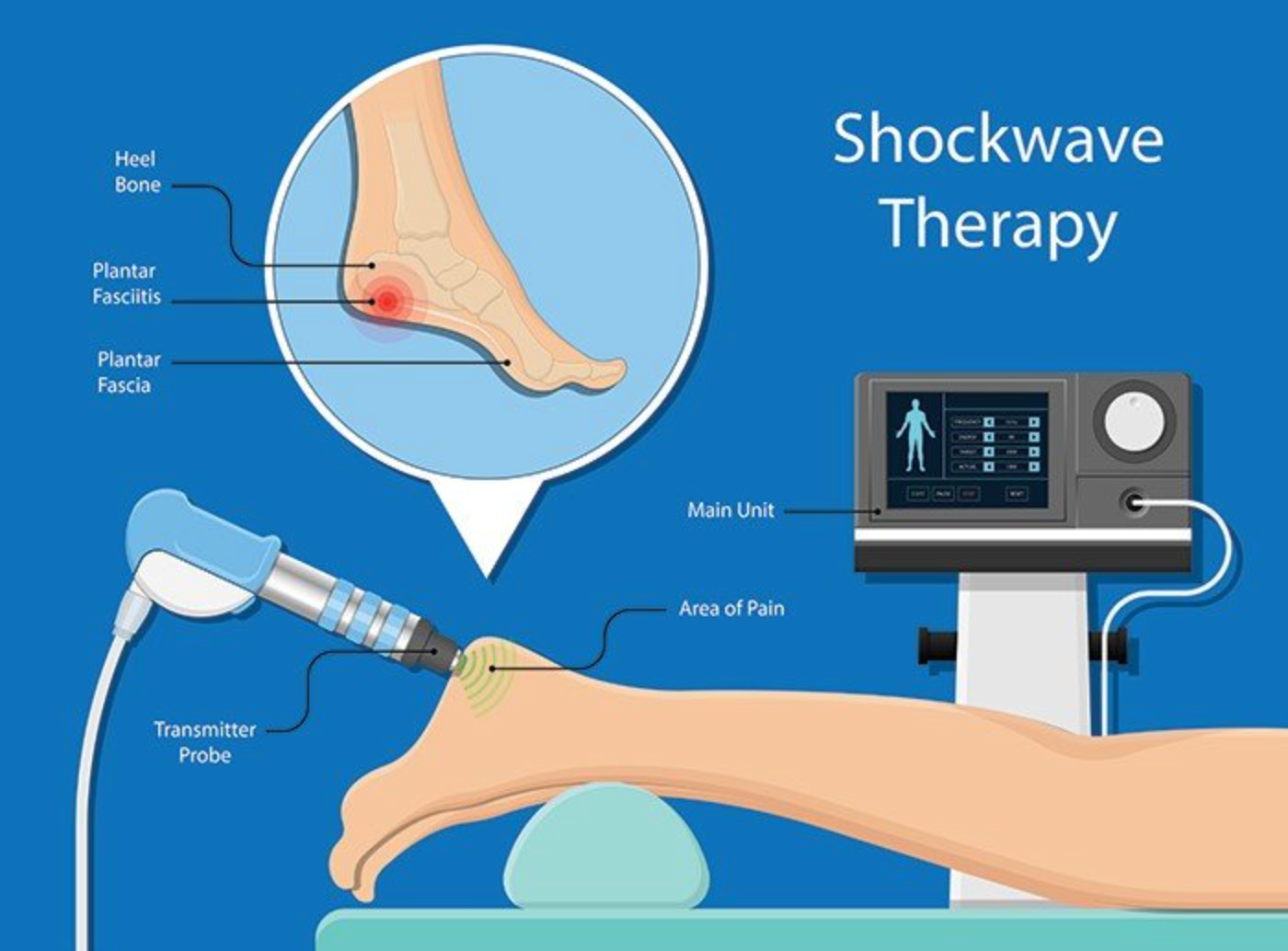 shockwave therapy