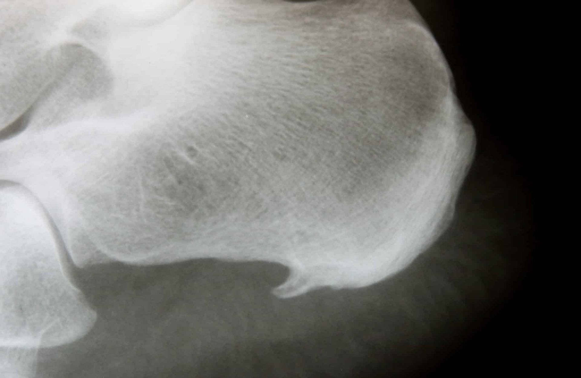 x-ray