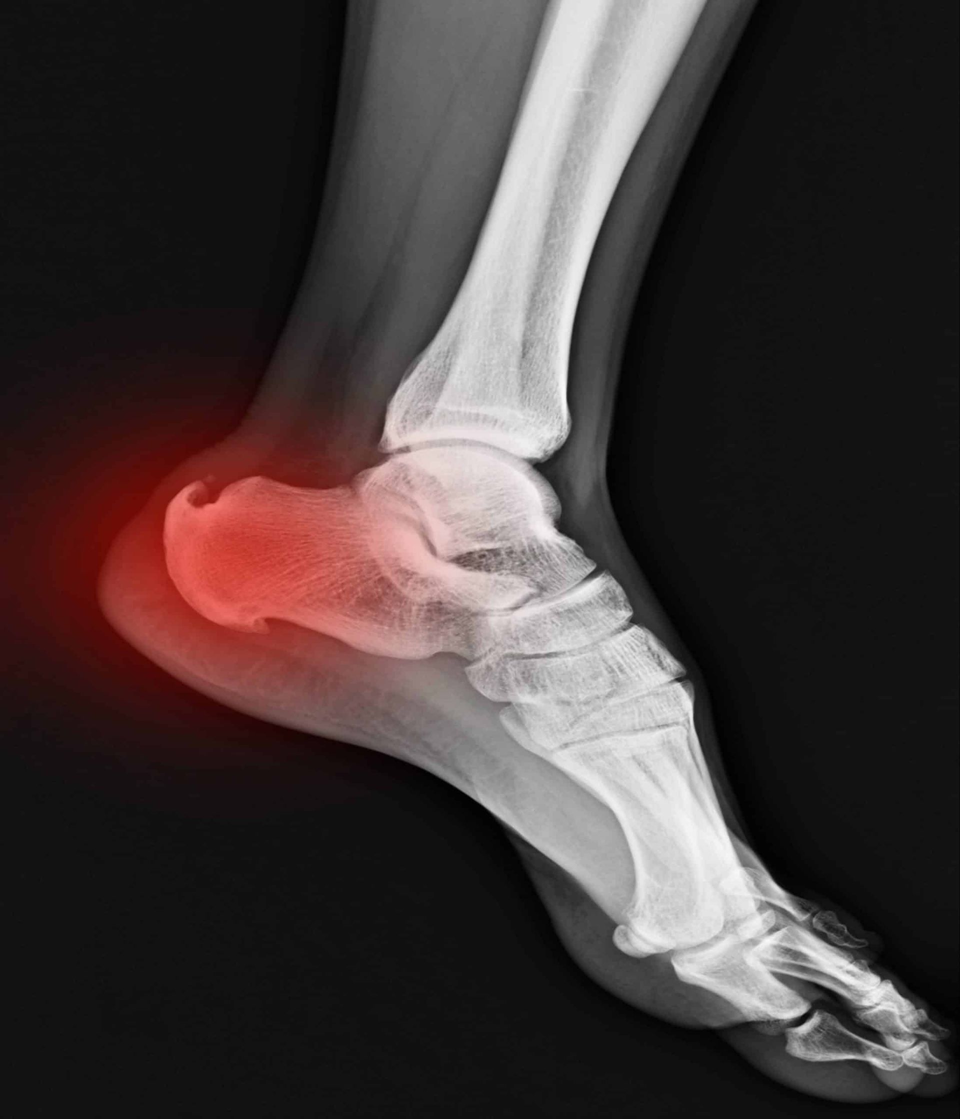bone spur