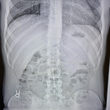 Spinal Canal Stenosis