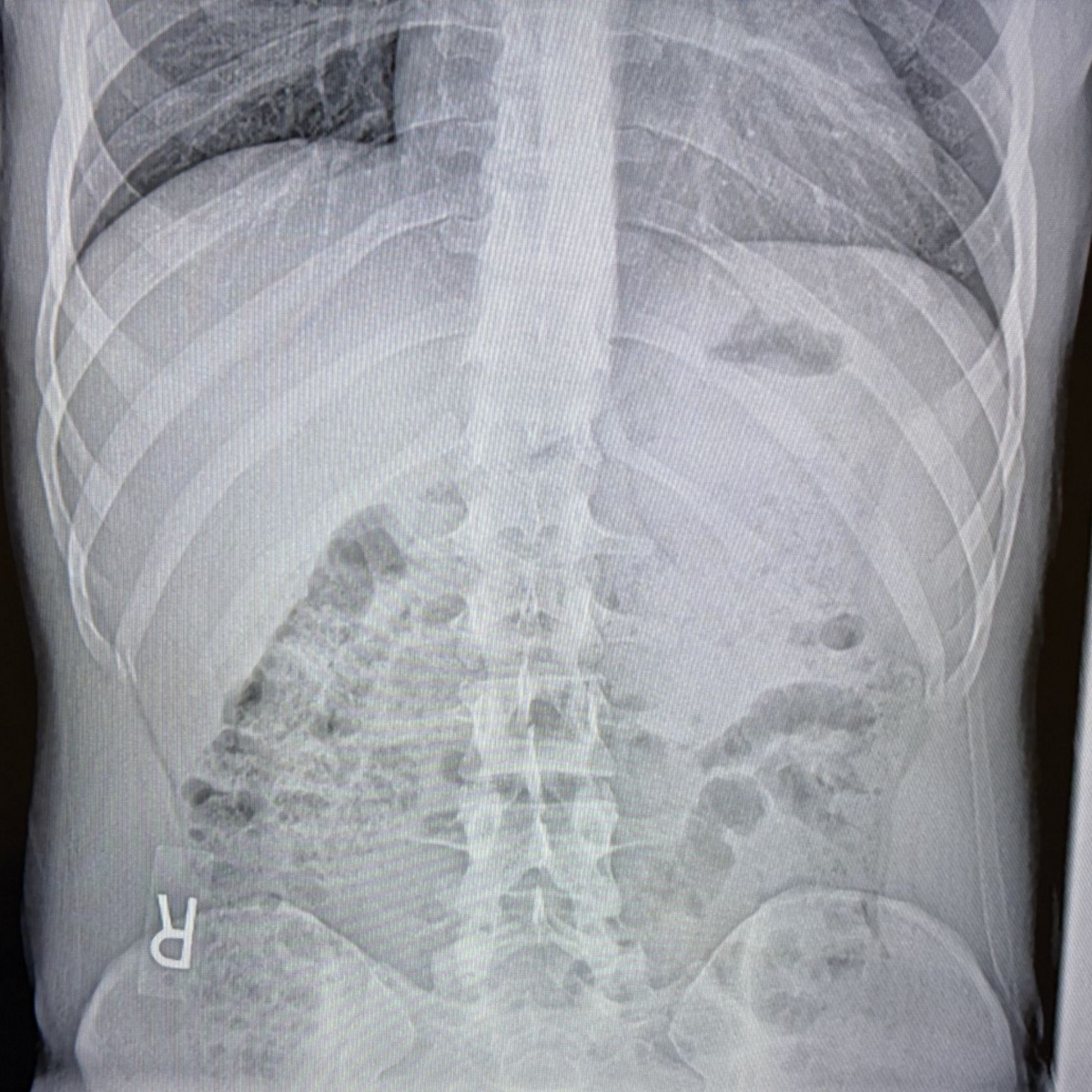 Spinal Canal Stenosis Treatment