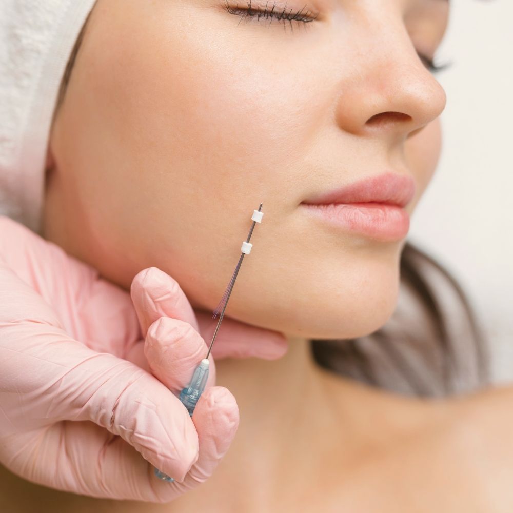 PDO thread lift treatment