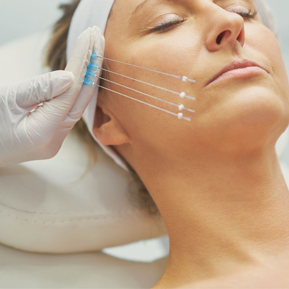 Facial thread lifting procedure