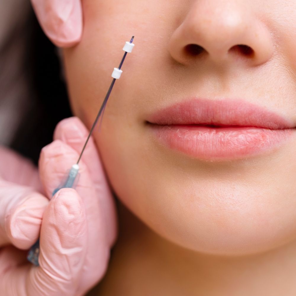 PDO thread lift treatment at Superior Health Medical and Wellness