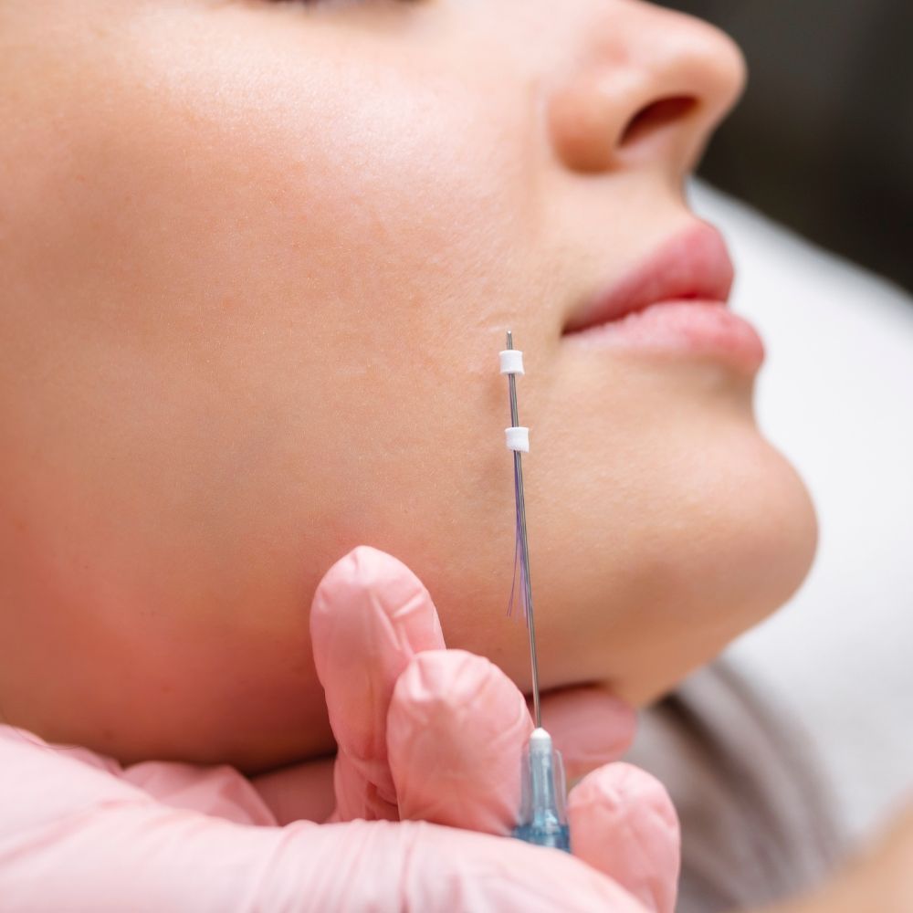 Facial thread lifting at Superior Health Medical and Wellness
