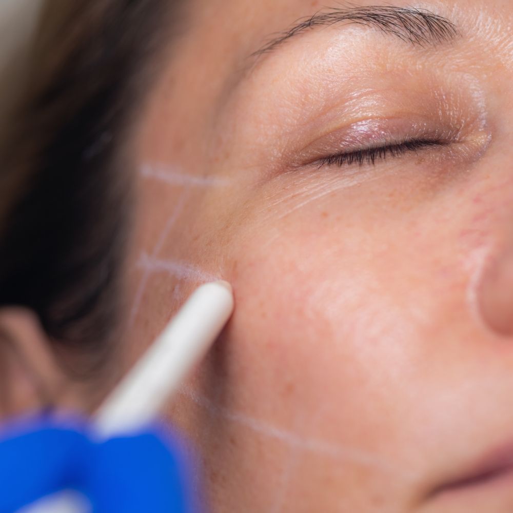 Facial thread lift recovery at Superior Health Medical