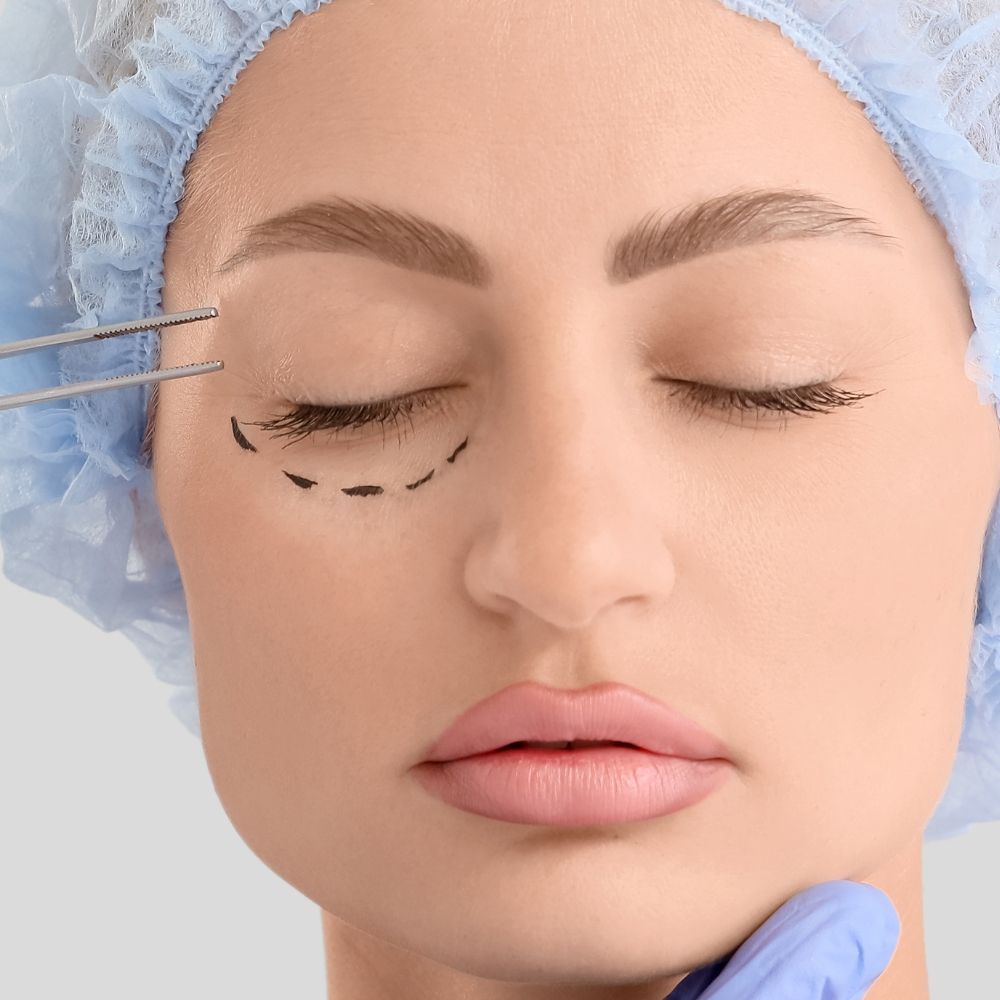 Non-surgical blepharoplasty at Superior Health Medical and Wellness