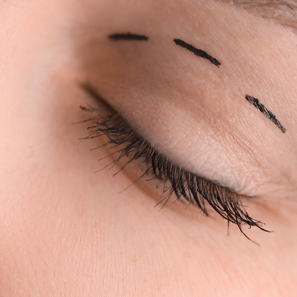 Non-surgical eye rejuvenation at Superior Health Medical