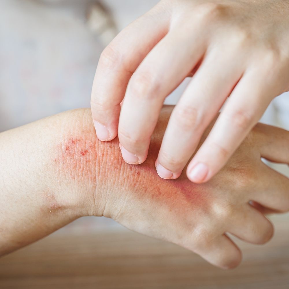 Eczema Treatment at Superior Health