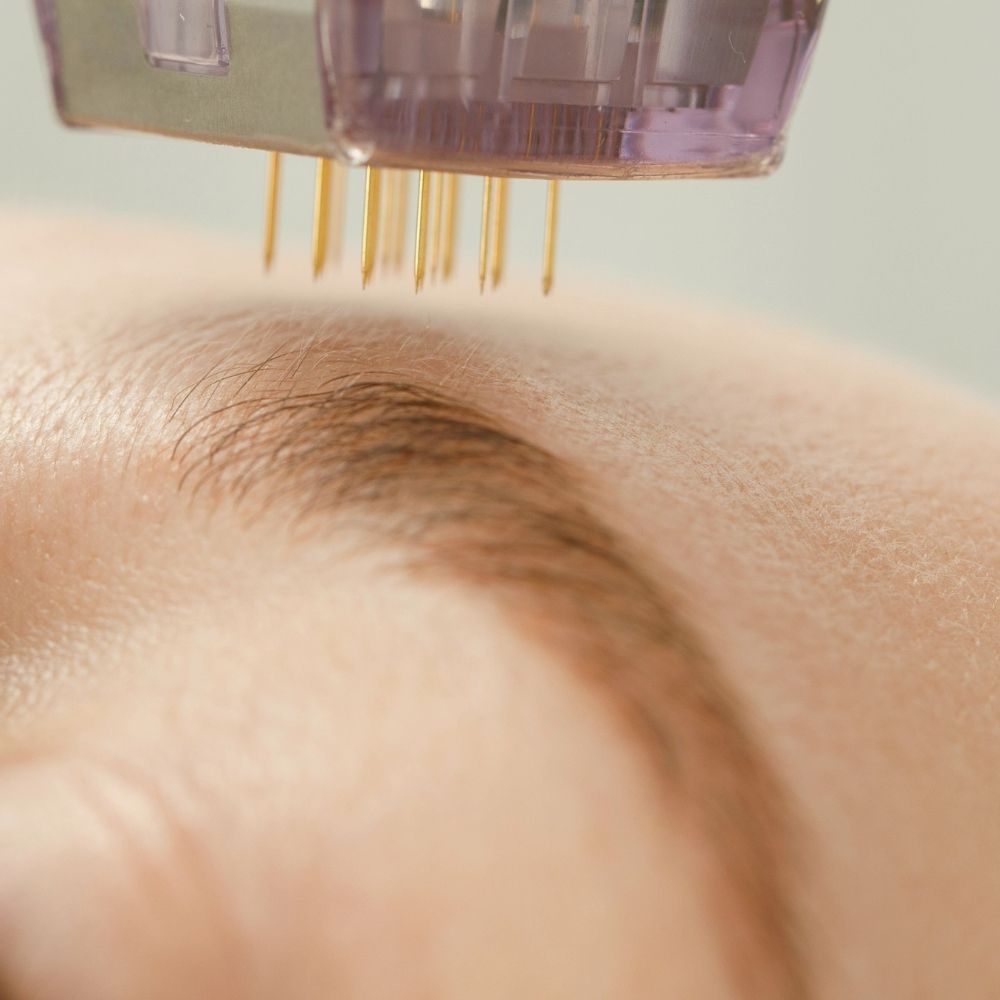 Microneedling skin treatment