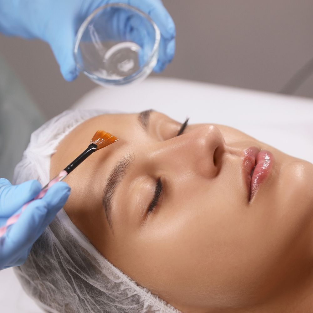 Chemical peel results at Superior Health Medical