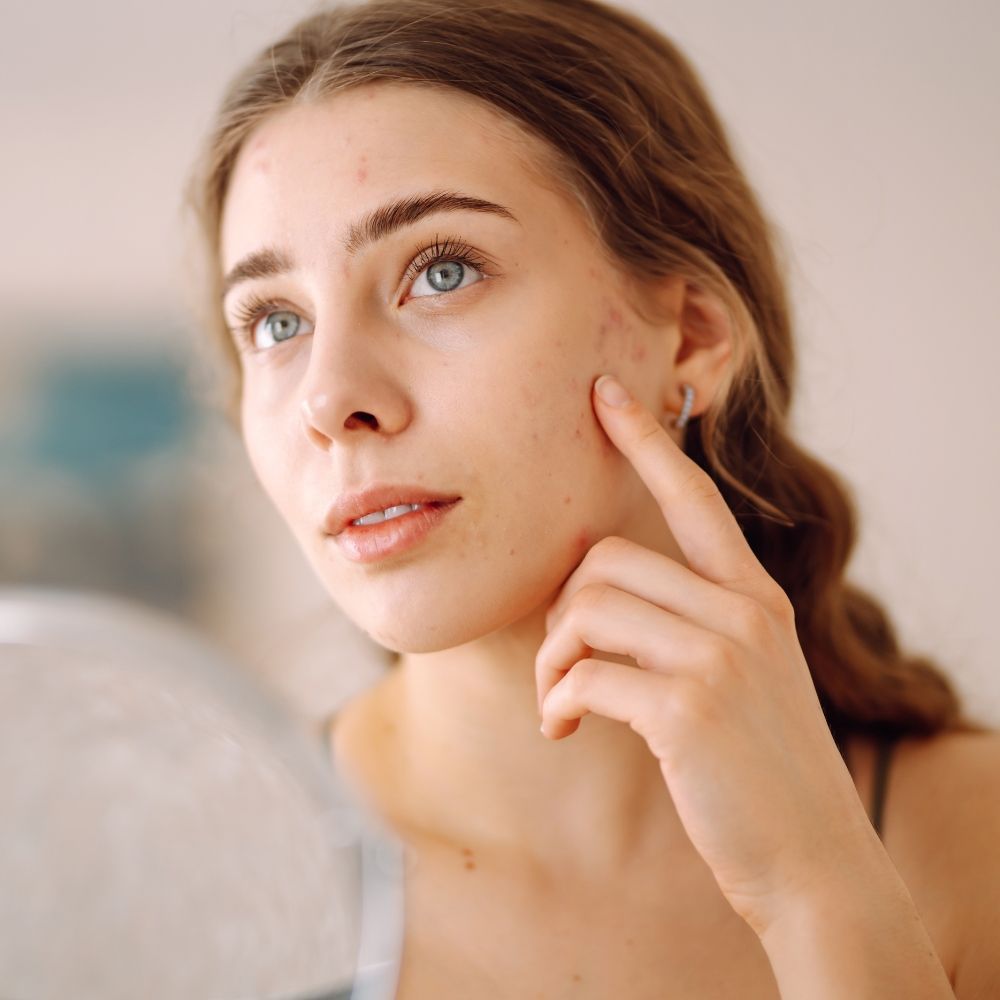 Acne scar treatment at Superior Health Medical and Wellness