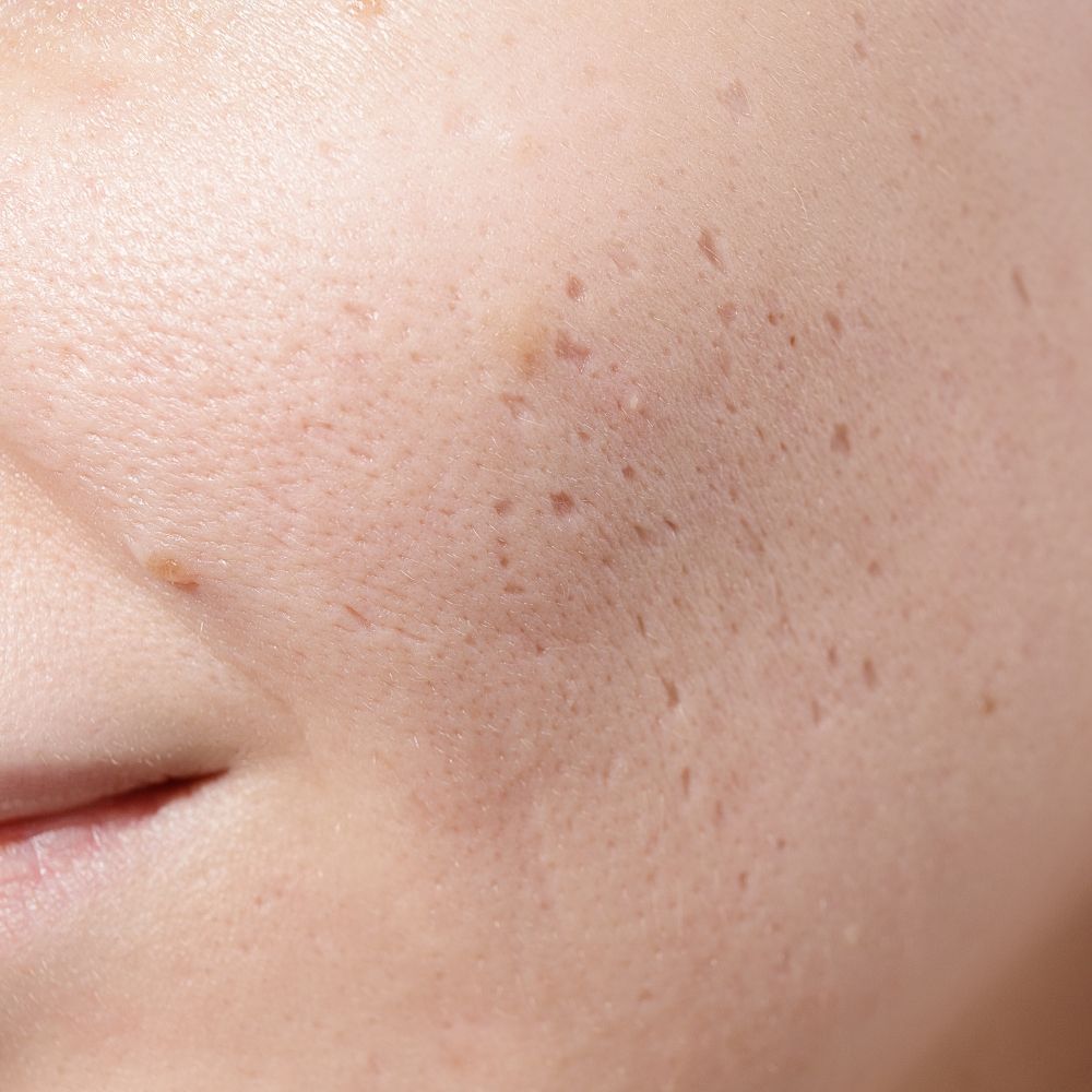 Acne scar treatment results at Superior Health Medical