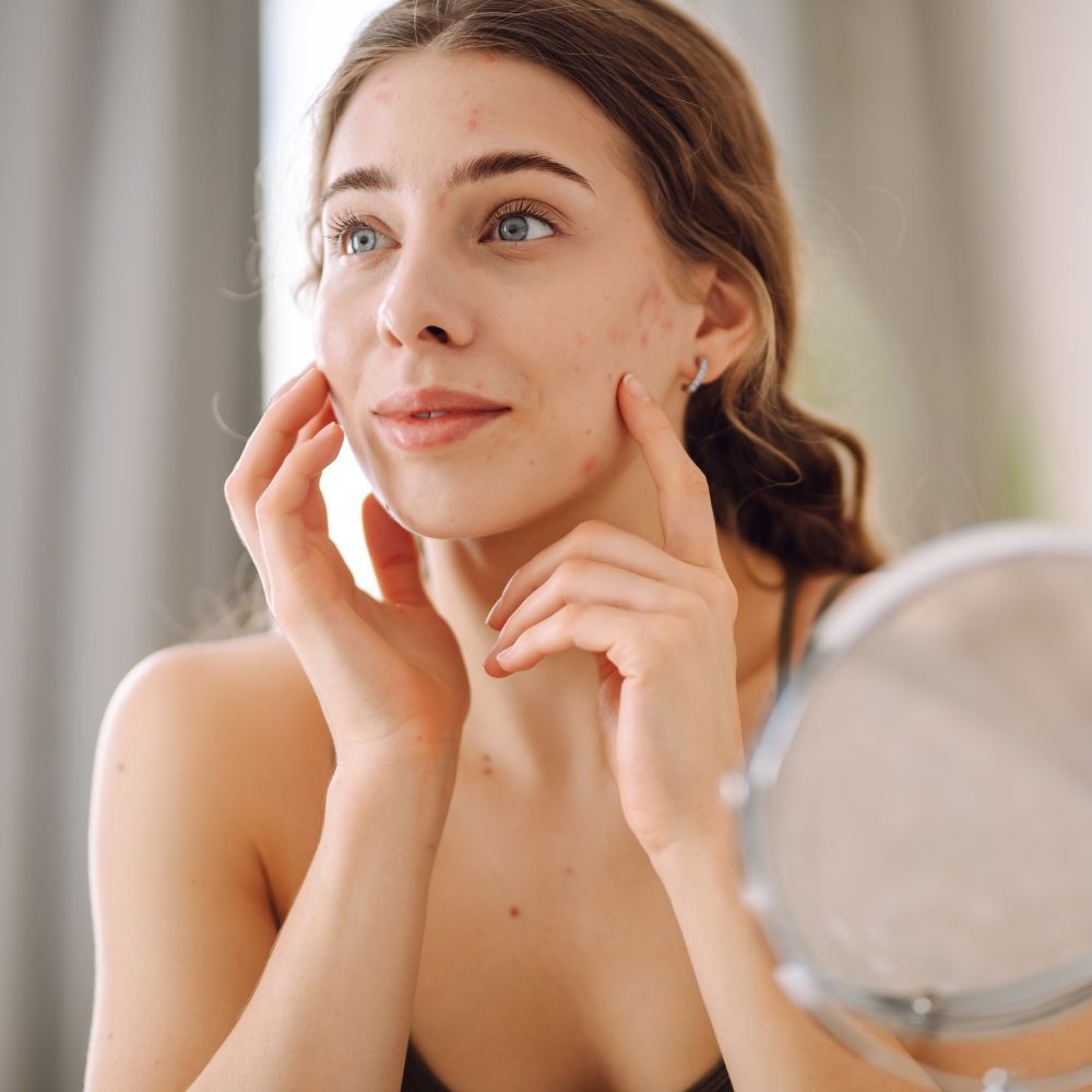 Acne scar treatment