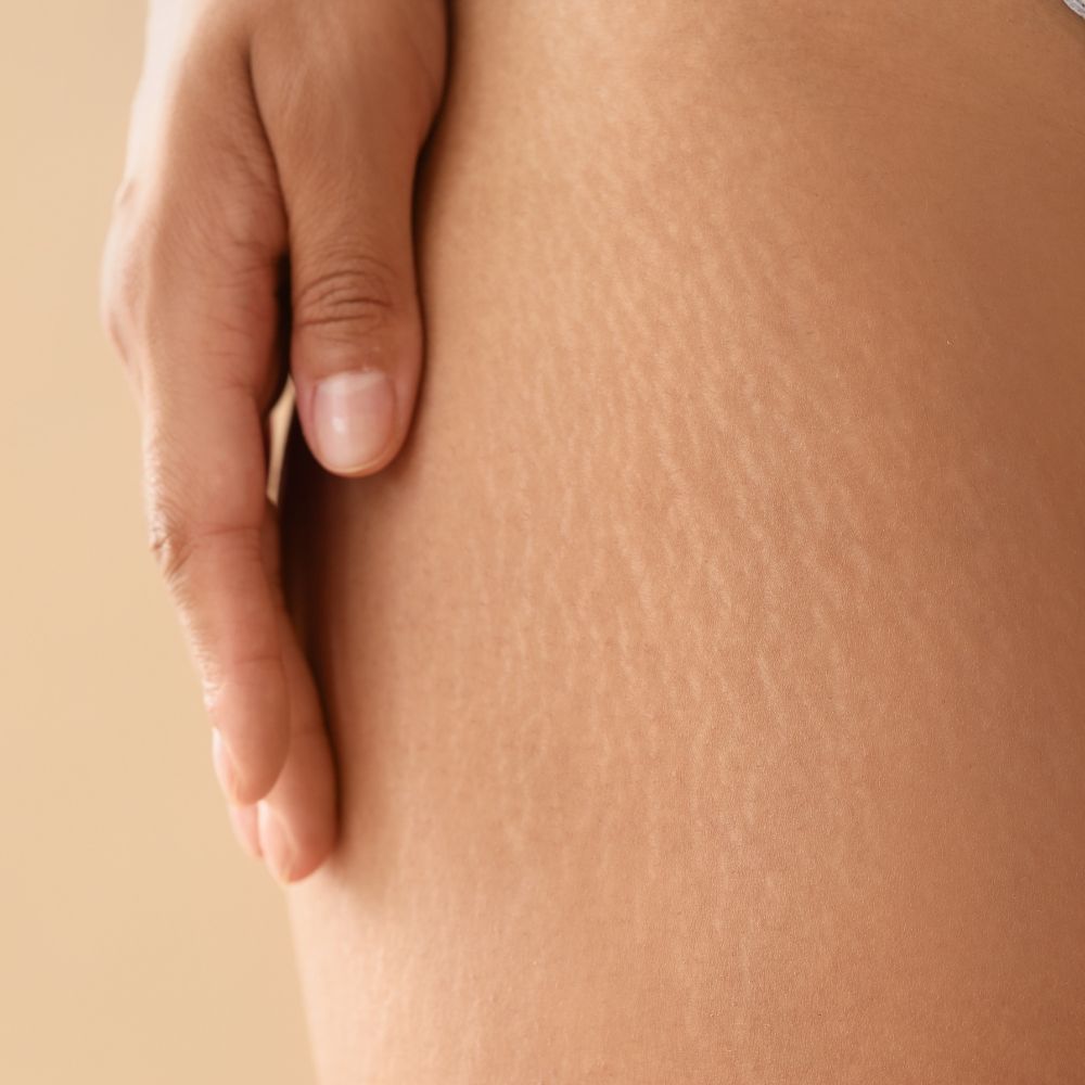 Stretch mark treatment results at Superior Health Medical