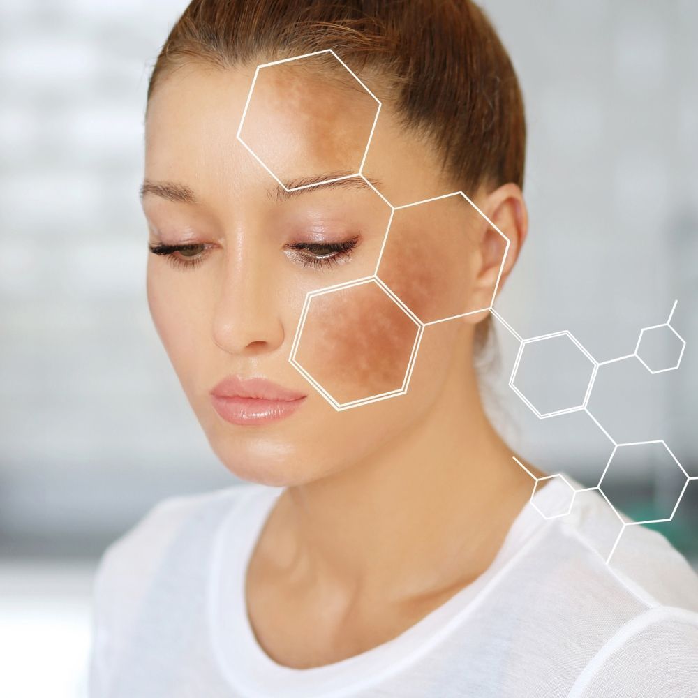 Melasma treatment at Superior Health Medical and Wellness