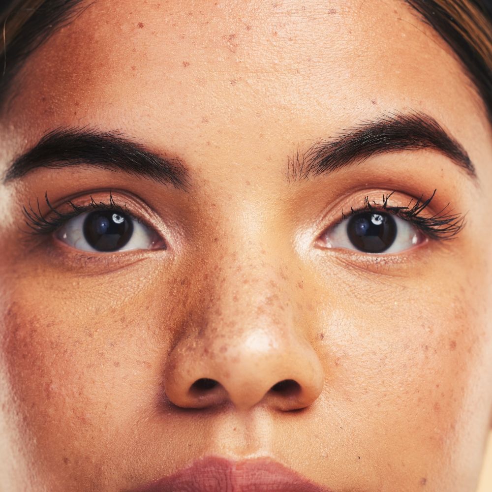 Melasma types and causes at Superior Health Medical