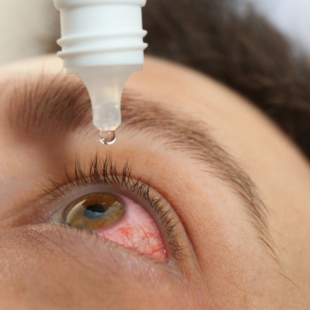 Pink eye conjunctivitis treatment at Superior Health Medical