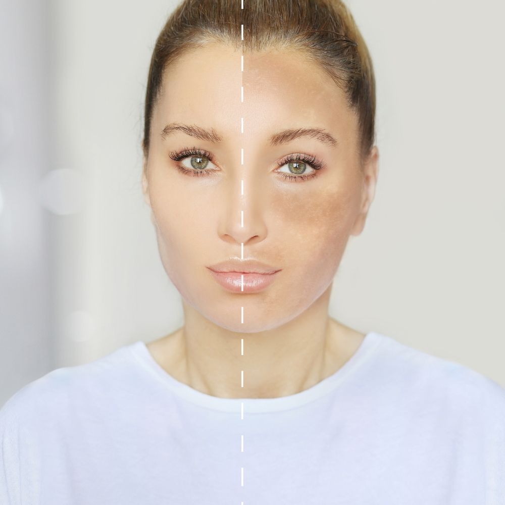 Melasma pigmentation treatment
