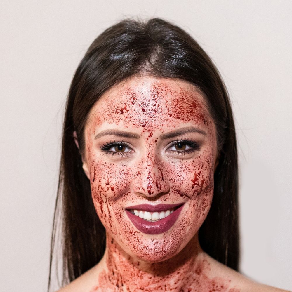 PRP blood facial treatment