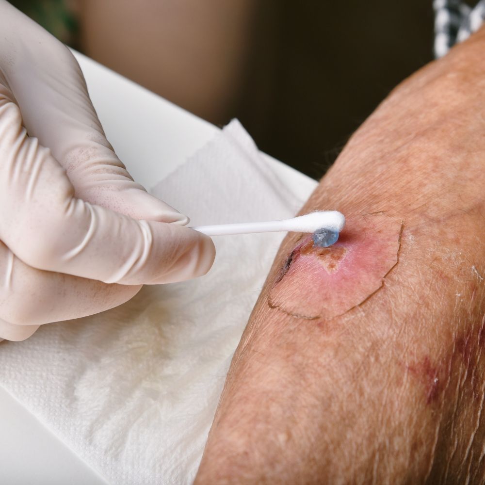 Wound infection evaluation at Superior Health Medical