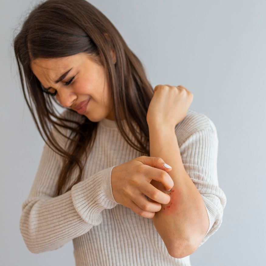 Eczema