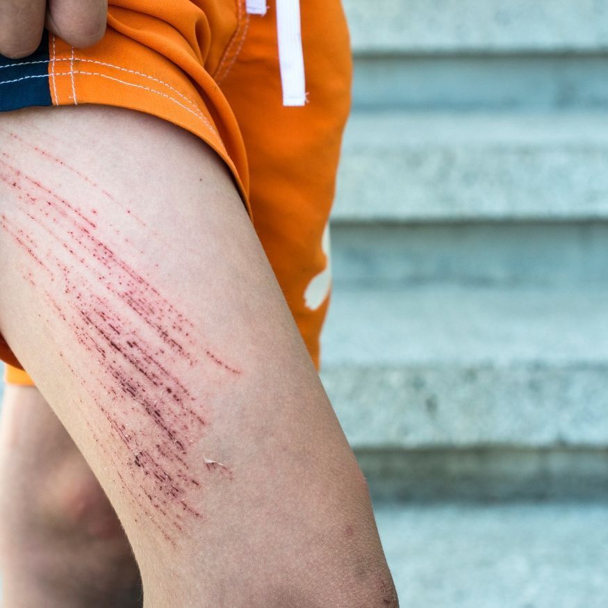 Minor Cuts