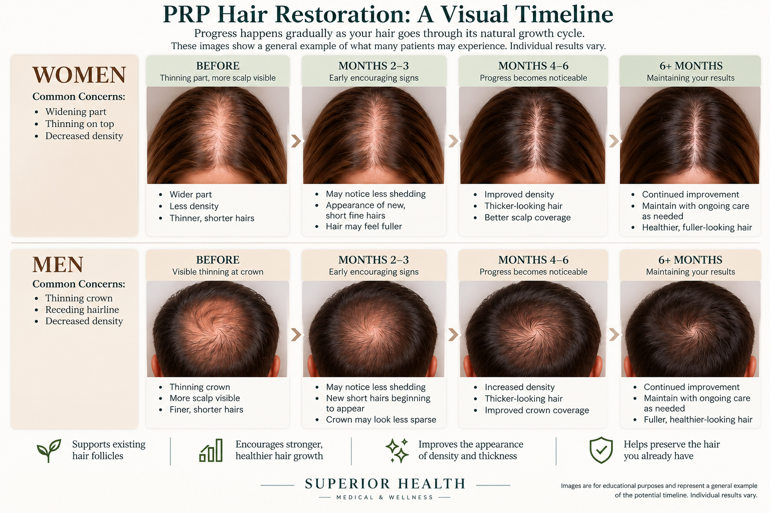 PRP hair restoration visual timeline for women and men: before, months 2 to 3, months 4 to 6, and 6 months and beyond