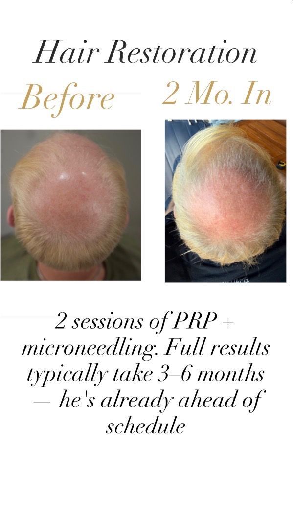 Before and after PRP hair restoration with microneedling, 2 months into treatment