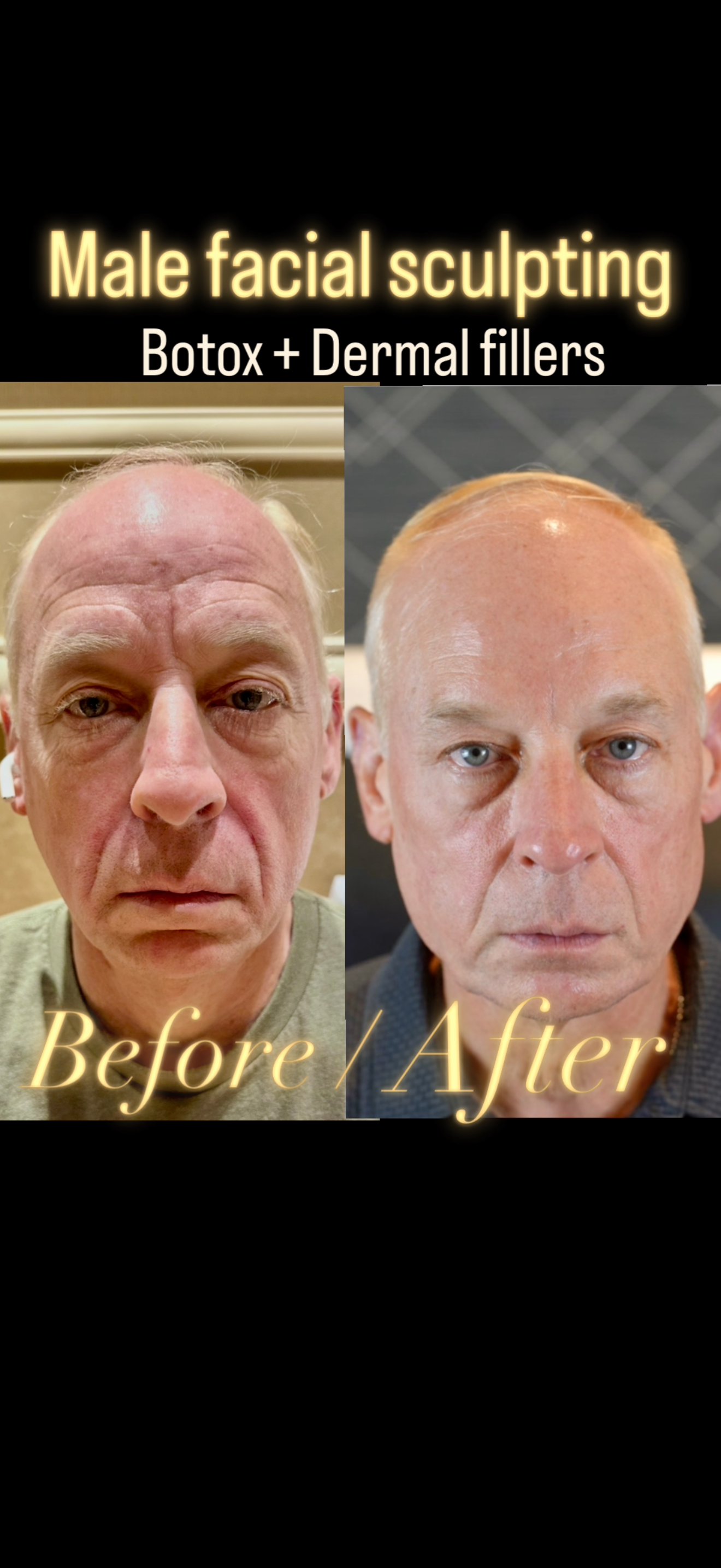 Before and after male facial sculpting with Botox and dermal fillers